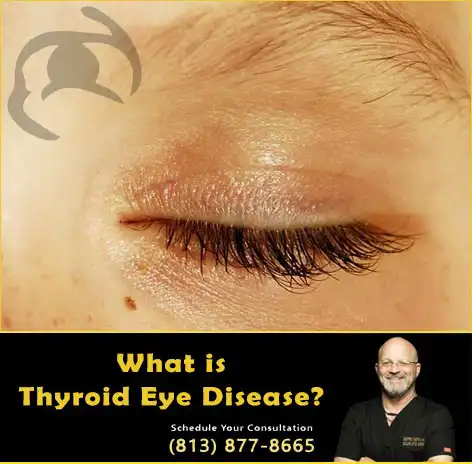 What is Thyroid Eye Disease