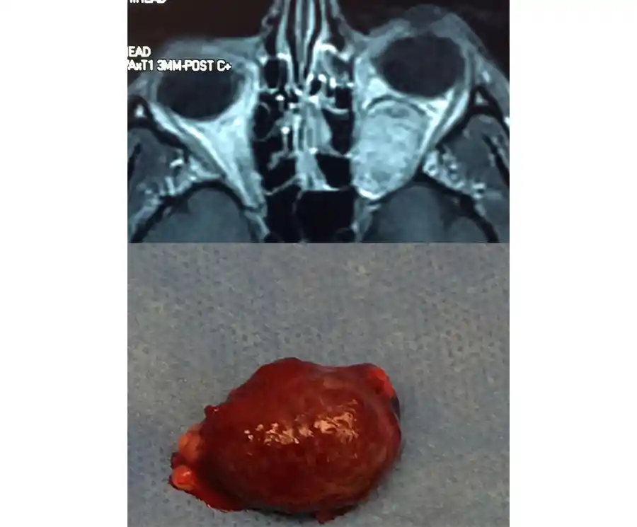 Orbital Surgery