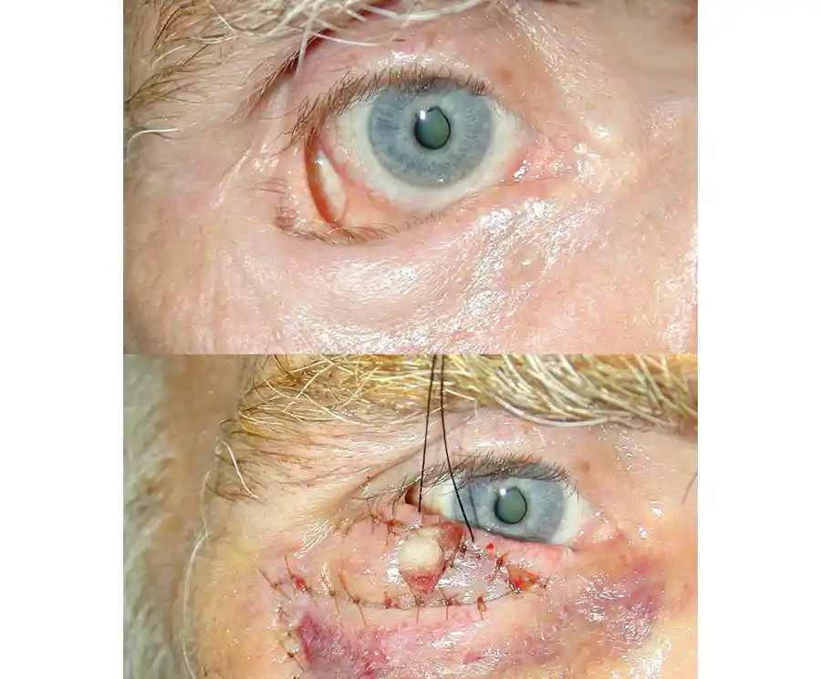 Reconstructive Eylid Surgery