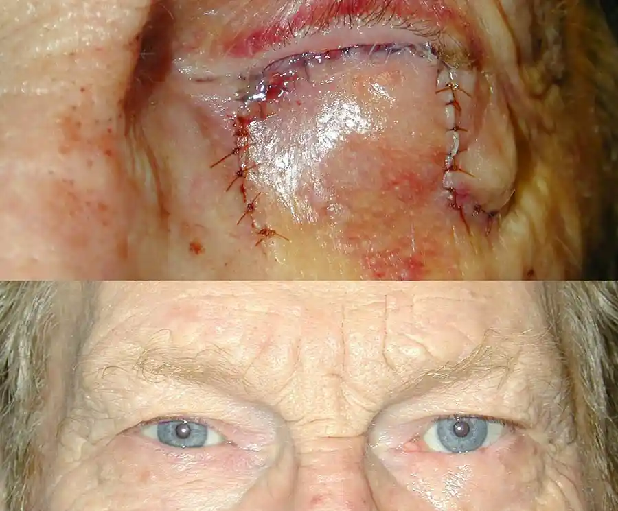 Reconstructive Eylid Surgery