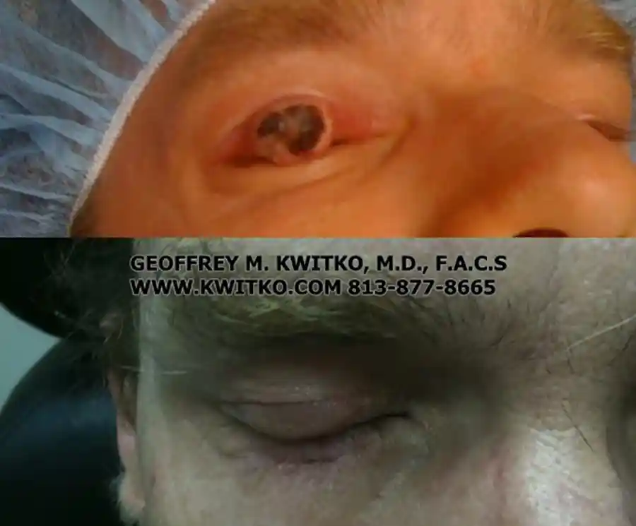 Reconstructive Eylid Surgery